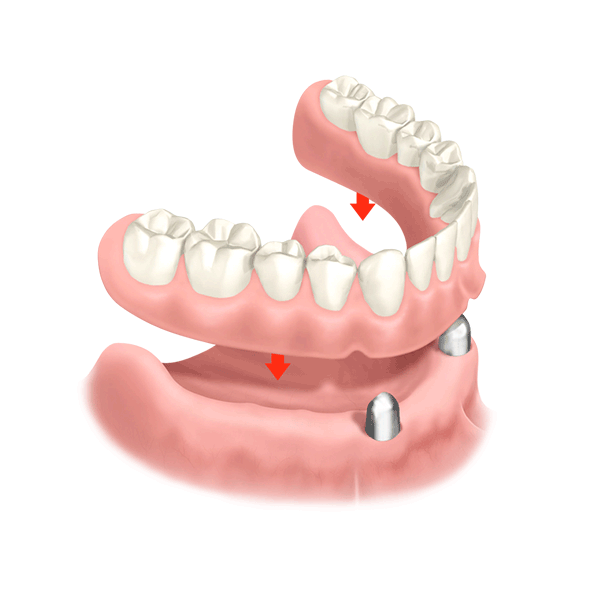 Coverdenture günstig smilodentax