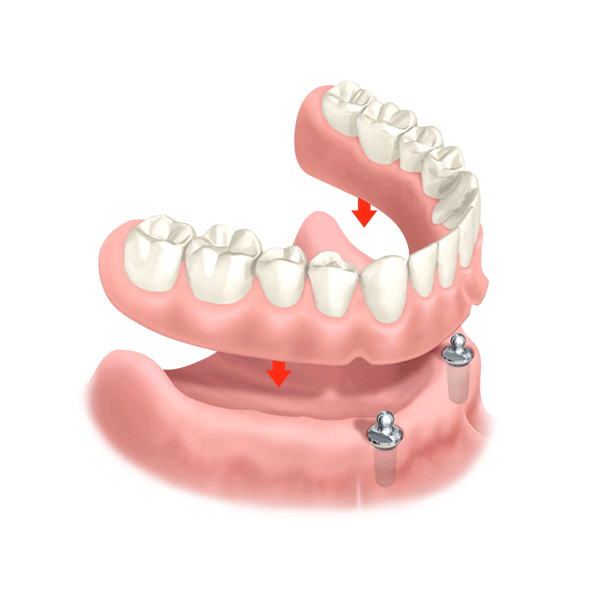 Kugelkopfprothese Zahnersatz günstig smilodentax