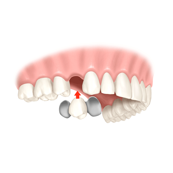 Maryland Brücke Zahnersatz günstig smilodentax