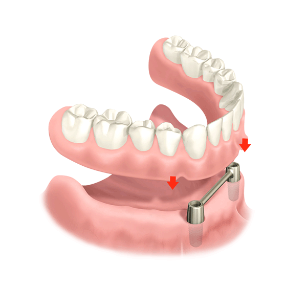Ankerprothese Zahnersatz günstig smilodentax